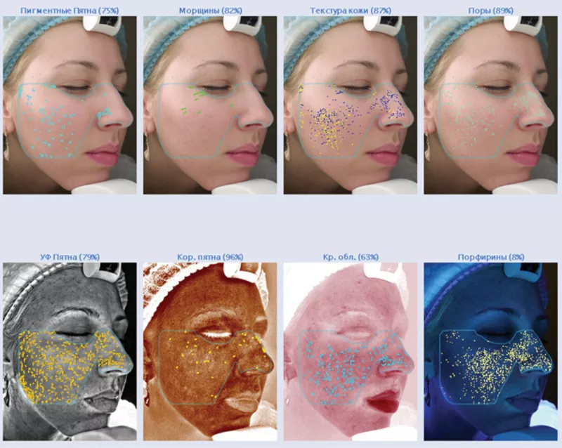 Комплексная диагностика кожи лица МедЭстет Винница. 3